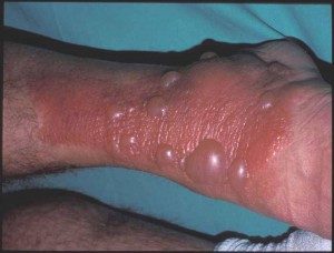 photosensibilisation 3