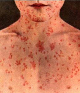 rougeole 2