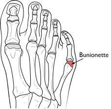 bunionette