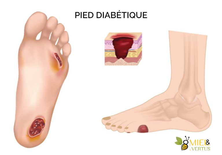 pied-diabetique
